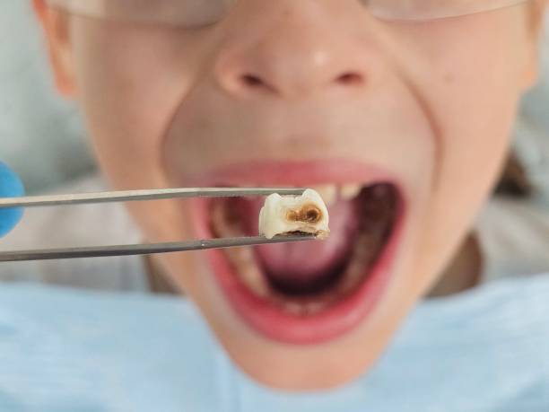 Best Root Canal Emergency Dentist  in Loyola, CA